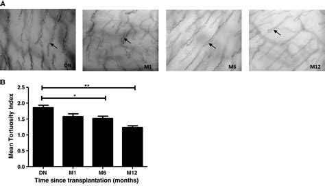 spkfu|Microvascular Damage in Type 1 Diabetic Patients Is Reversed in .